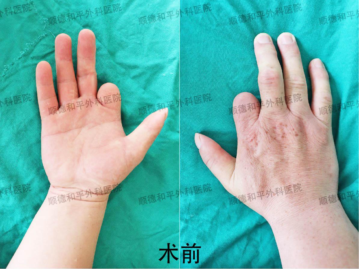 新疆患者失去手指心生自卑，遠赴廣東手指再造＿手外科醫院咨詢(圖1)