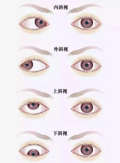 愛(ài)爾眼科：總愛(ài)偏頭看，視力“一好一壞”？警惕斜視！